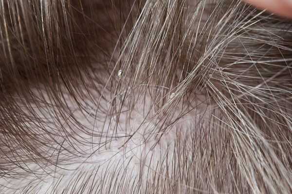 The difference in the Symptoms of Lice VS Dandruff 