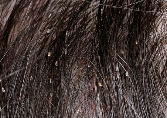 How to Treat Lice? 