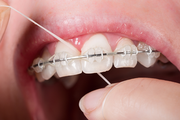 Can I Floss With My Braces On?