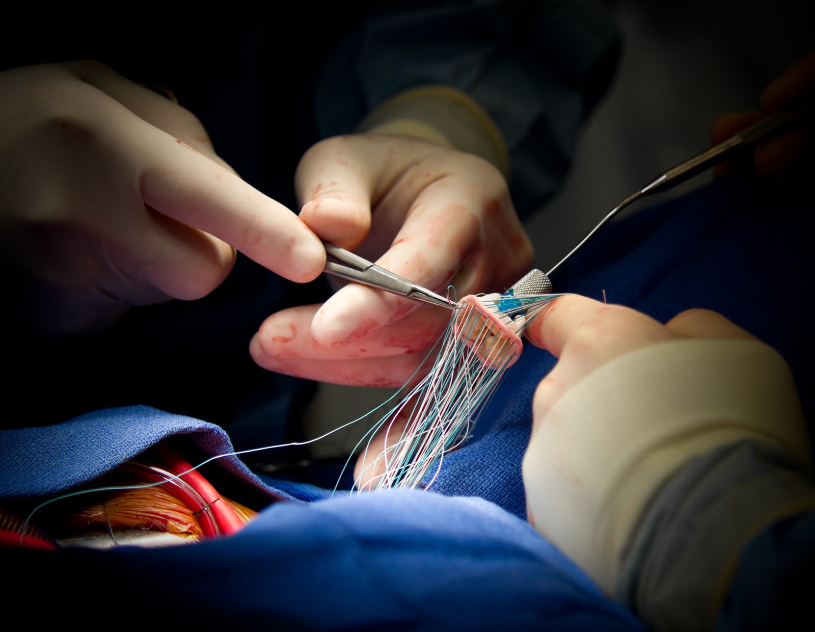 HEART VALVE REPLACEMENT