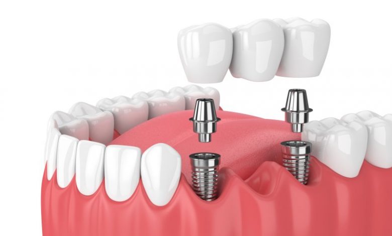 Is it common for dental implants to fail?